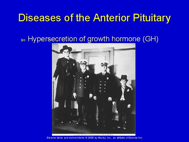 Diseases of the Anterior Pituitary Hypersecretion of growth hormone (GH) Elsevier items and derived