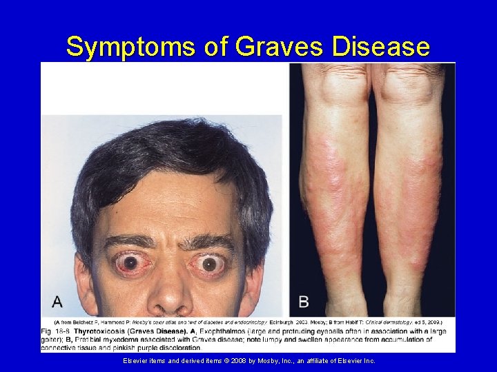 Symptoms of Graves Disease Elsevier items and derived items © 2008 by Mosby, Inc.