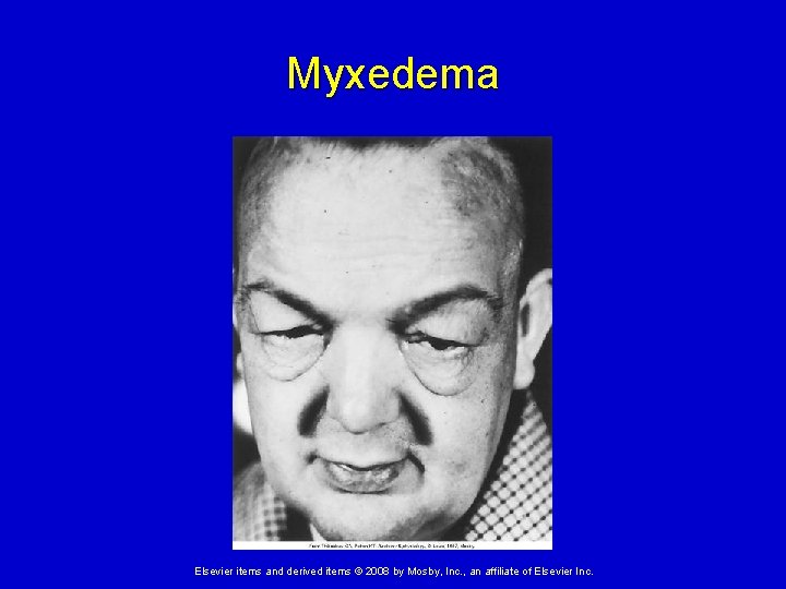 Myxedema Elsevier items and derived items © 2008 by Mosby, Inc. , an affiliate