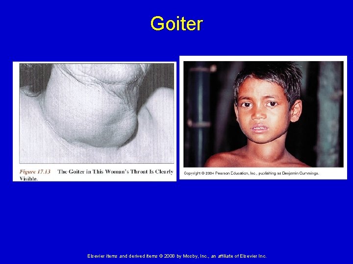 Goiter Elsevier items and derived items © 2008 by Mosby, Inc. , an affiliate