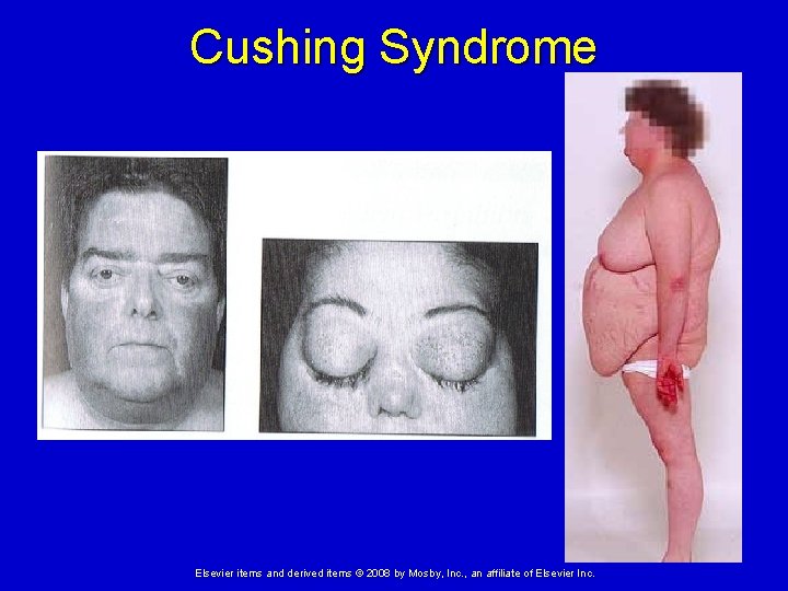Cushing Syndrome Elsevier items and derived items © 2008 by Mosby, Inc. , an