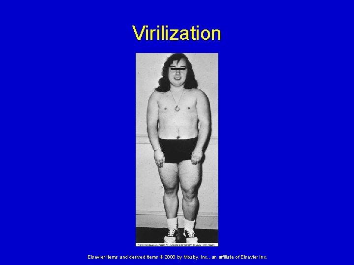 Virilization Elsevier items and derived items © 2008 by Mosby, Inc. , an affiliate