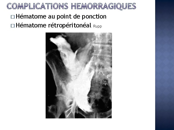 � Hématome au point de ponction � Hématome rétropéritonéal Rupp 