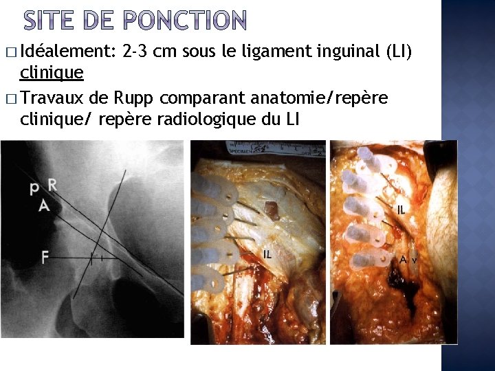 � Idéalement: 2 -3 cm sous le ligament inguinal (LI) clinique � Travaux de