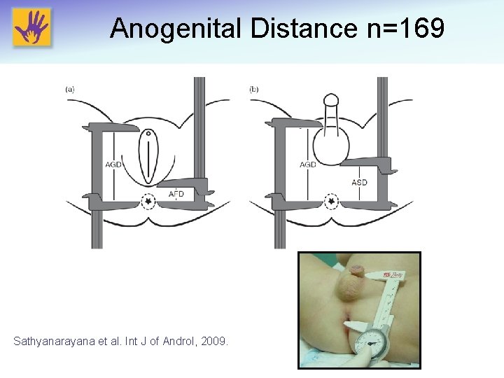 Anogenital Distance n=169 Sathyanarayana et al. Int J of Androl, 2009. 