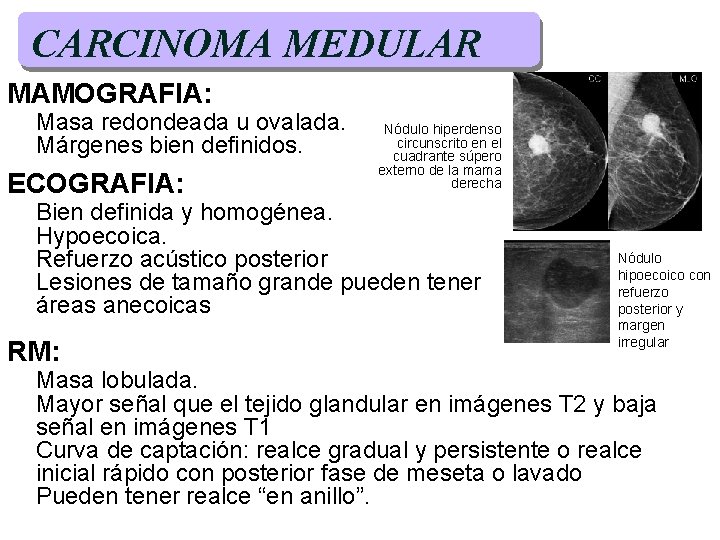 CARCINOMA MEDULAR MAMOGRAFIA: Masa redondeada u ovalada. Márgenes bien definidos. ECOGRAFIA: Nódulo hiperdenso circunscrito CARCINOMA MEDULAR MAMOGRAFIA: Masa redondeada u ovalada. Márgenes bien definidos. ECOGRAFIA: Nódulo hiperdenso circunscrito
