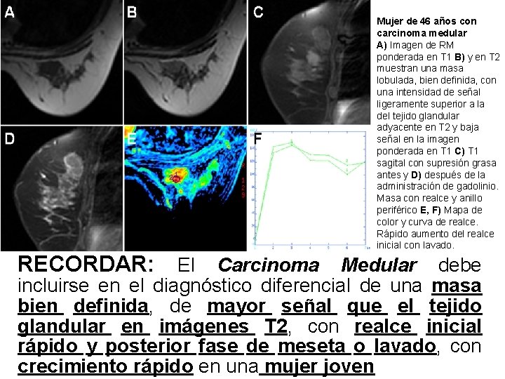 Mujer de 46 años con carcinoma medular A) Imagen de RM ponderada en T Mujer de 46 años con carcinoma medular A) Imagen de RM ponderada en T