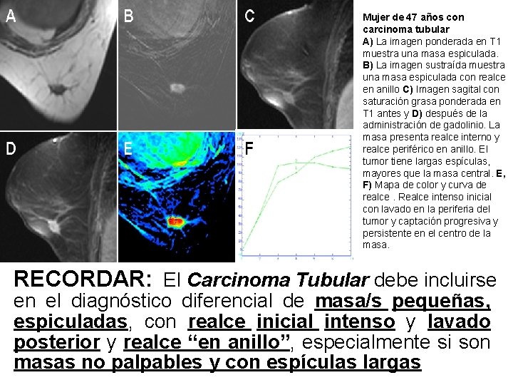 Mujer de 47 años con carcinoma tubular A) La imagen ponderada en T 1 Mujer de 47 años con carcinoma tubular A) La imagen ponderada en T 1
