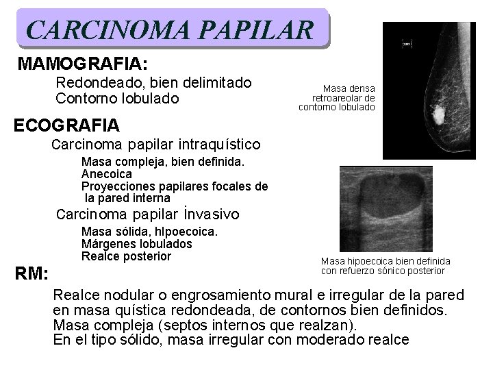 CARCINOMA PAPILAR CC MAMOGRAFIA: Redondeado, bien delimitado Contorno lobulado Masa densa retroareolar de contorno CARCINOMA PAPILAR CC MAMOGRAFIA: Redondeado, bien delimitado Contorno lobulado Masa densa retroareolar de contorno