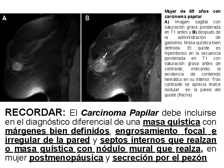 Mujer de 65 años con carcinoma papilar A) Imagen sagital con saturación grasa ponderada Mujer de 65 años con carcinoma papilar A) Imagen sagital con saturación grasa ponderada