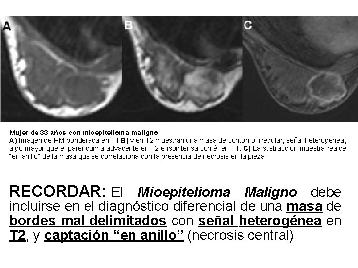 Mujer de 33 años con mioepitelioma maligno A) Imagen de RM ponderada en T Mujer de 33 años con mioepitelioma maligno A) Imagen de RM ponderada en T