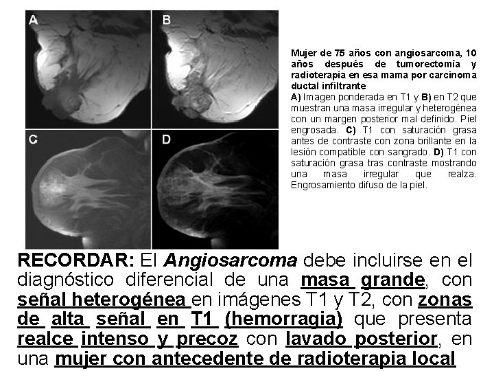 Mujer de 75 años con angiosarcoma, 10 años después de tumorectomía y radioterapia en Mujer de 75 años con angiosarcoma, 10 años después de tumorectomía y radioterapia en
