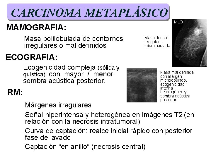 CARCINOMA METAPLÁSICO MLO MAMOGRAFIA: Masa polilobulada de contornos irregulares o mal definidos Masa densa CARCINOMA METAPLÁSICO MLO MAMOGRAFIA: Masa polilobulada de contornos irregulares o mal definidos Masa densa