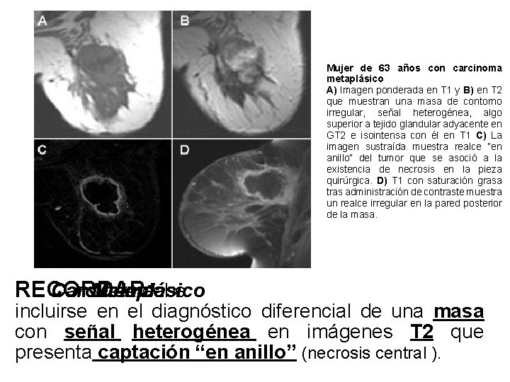 Mujer de 63 años con carcinoma metaplásico A) Imagen ponderada en T 1 y Mujer de 63 años con carcinoma metaplásico A) Imagen ponderada en T 1 y
