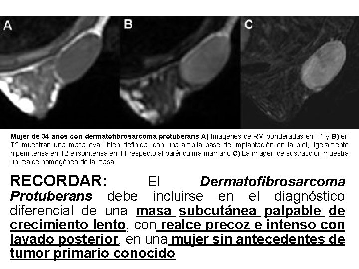 Mujer de 34 años con dermatofibrosarcoma protuberans A) Imágenes de RM ponderadas en T Mujer de 34 años con dermatofibrosarcoma protuberans A) Imágenes de RM ponderadas en T