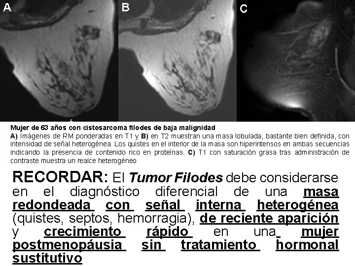 Mujer de 63 años con cistosarcoma filodes de baja malignidad A) Imágenes de RM Mujer de 63 años con cistosarcoma filodes de baja malignidad A) Imágenes de RM