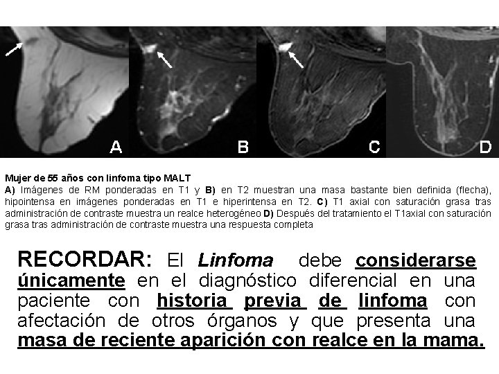 Mujer de 55 años con linfoma tipo MALT A) Imágenes de RM ponderadas en Mujer de 55 años con linfoma tipo MALT A) Imágenes de RM ponderadas en