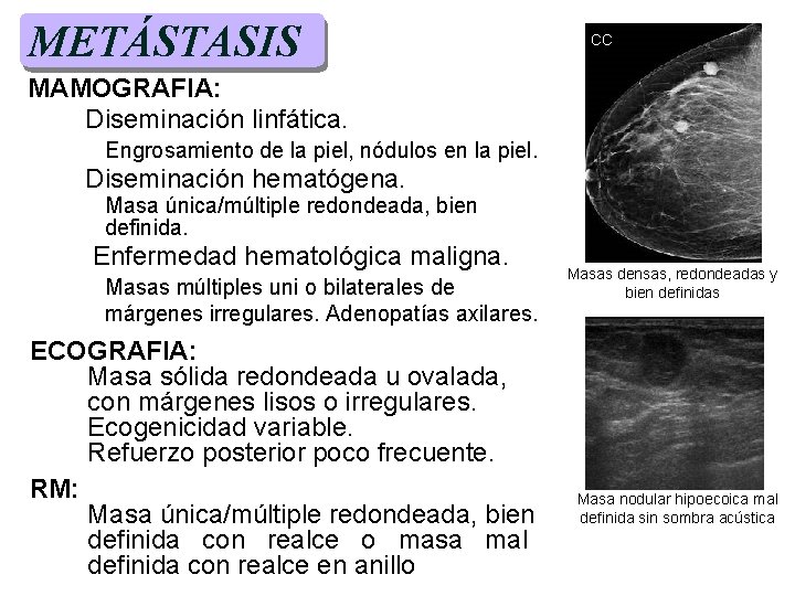 METÁSTASIS CC MAMOGRAFIA: Diseminación linfática. Engrosamiento de la piel, nódulos en la piel. Diseminación METÁSTASIS CC MAMOGRAFIA: Diseminación linfática. Engrosamiento de la piel, nódulos en la piel. Diseminación
