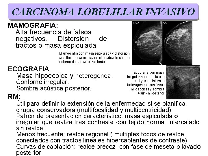 CARCINOMA LOBULILLAR INVASIVO MAMOGRAFIA: Alta frecuencia de falsos negativos. Distorsión de tractos o masa CARCINOMA LOBULILLAR INVASIVO MAMOGRAFIA: Alta frecuencia de falsos negativos. Distorsión de tractos o masa