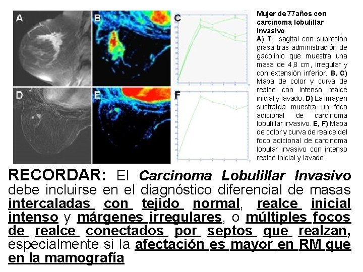 Mujer de 77 años con carcinoma lobulillar invasivo A) T 1 sagital con supresión Mujer de 77 años con carcinoma lobulillar invasivo A) T 1 sagital con supresión