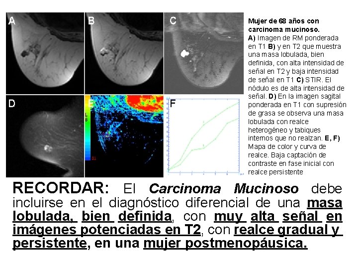Mujer de 68 años con carcinoma mucinoso. A) Imagen de RM ponderada en T Mujer de 68 años con carcinoma mucinoso. A) Imagen de RM ponderada en T