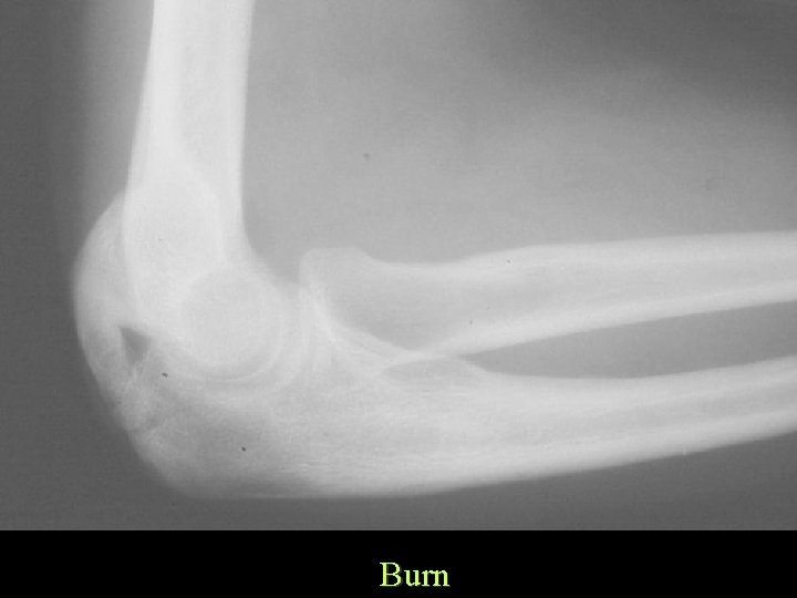 Burn 