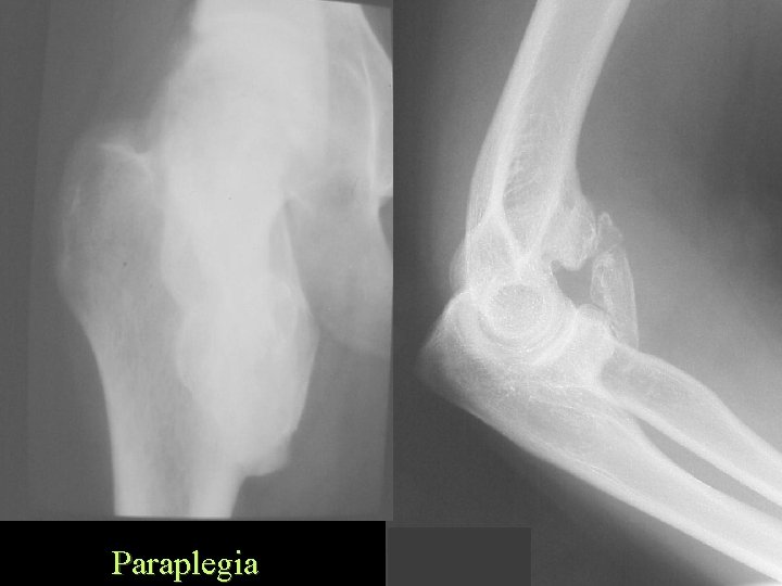 Paraplegia 
