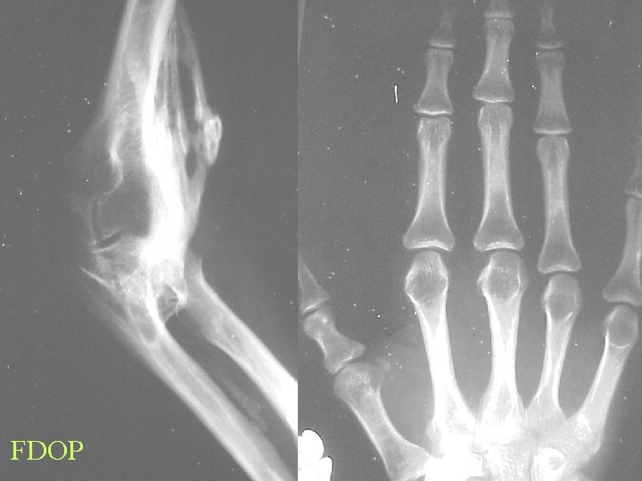 FDOP 