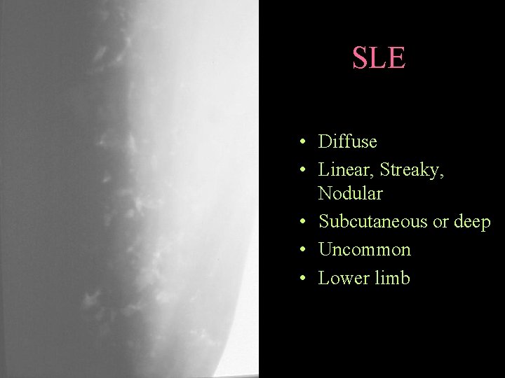 SLE • Diffuse • Linear, Streaky, Nodular • Subcutaneous or deep • Uncommon •