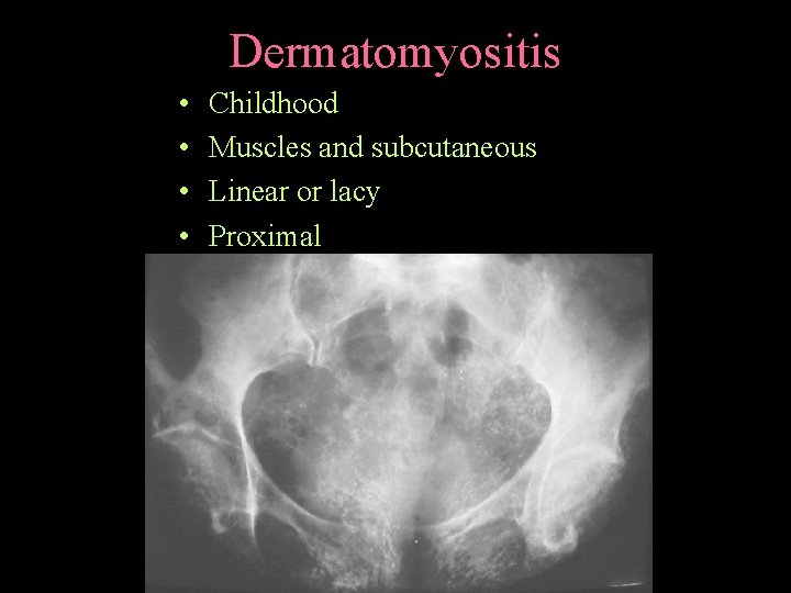 Dermatomyositis • • Childhood Muscles and subcutaneous Linear or lacy Proximal 