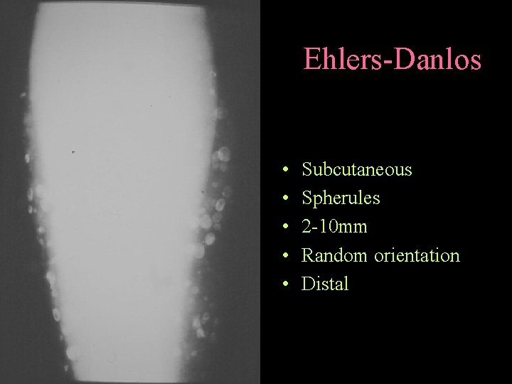 Ehlers-Danlos • • • Subcutaneous Spherules 2 -10 mm Random orientation Distal 