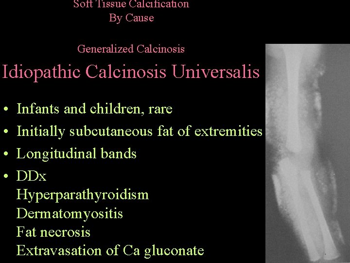 Soft Tissue Calcification By Cause Generalized Calcinosis Idiopathic Calcinosis Universalis • • Infants and