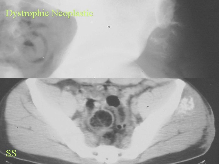 Dystrophic Neoplastic SS 