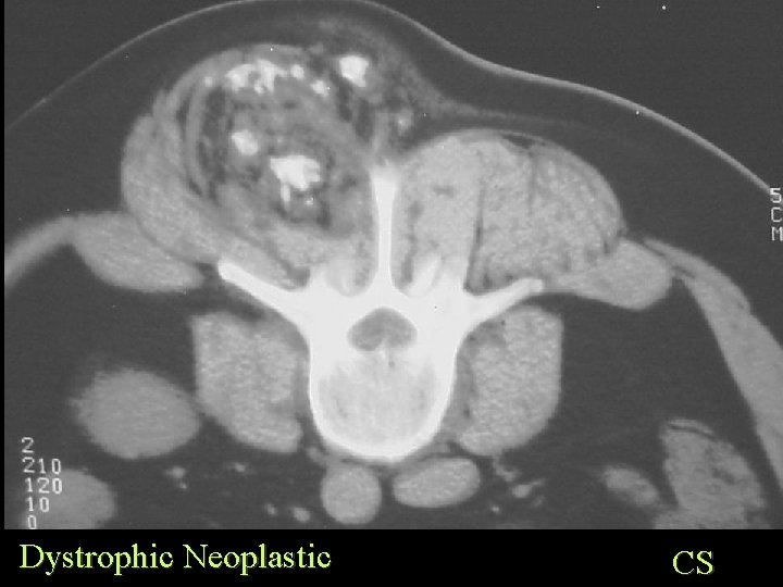 Dystrophic Neoplastic CS 