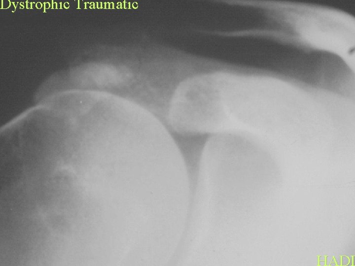 Dystrophic Traumatic HADD 