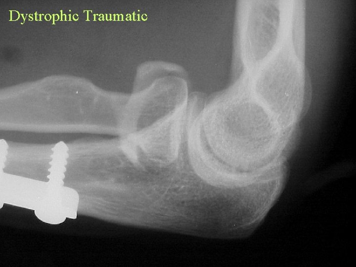 Dystrophic Traumatic 