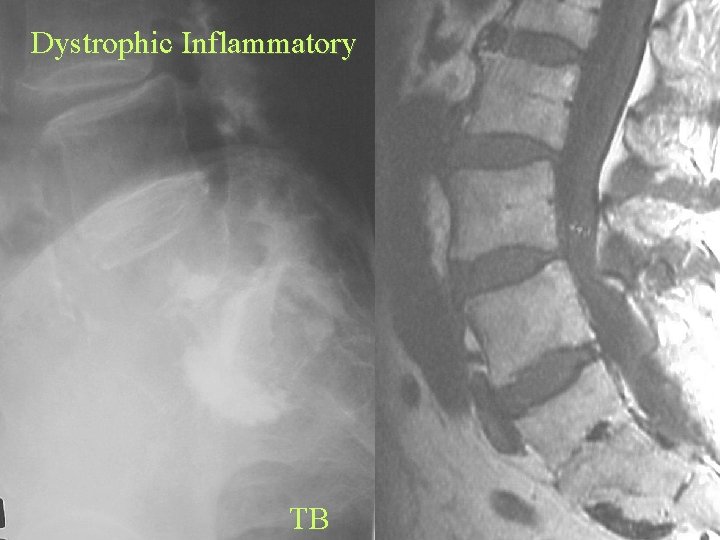 Dystrophic Inflammatory TB 