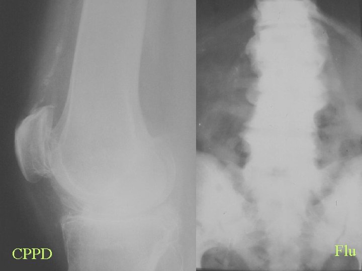CPPD Flu 