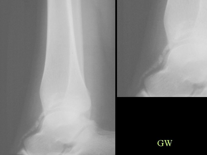 GW 