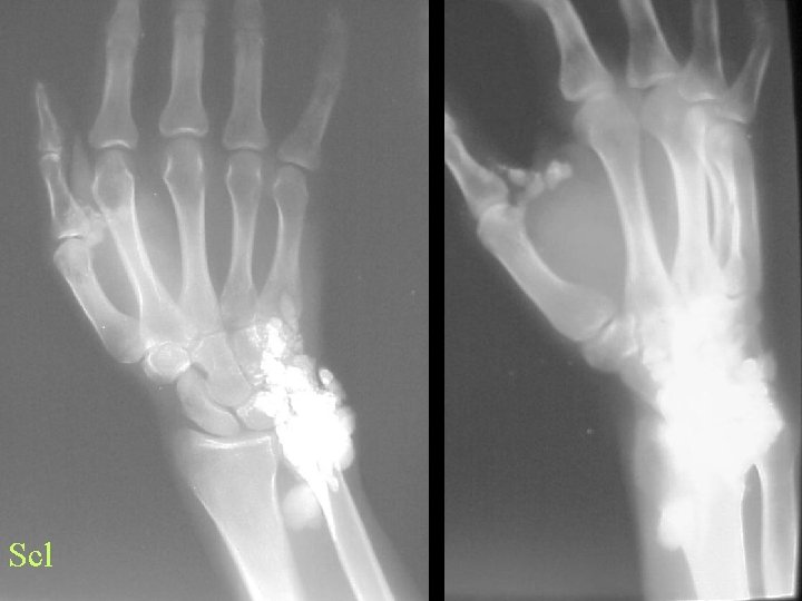 Scl 