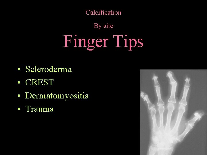 Calcification By site Finger Tips • • Scleroderma CREST Dermatomyositis Trauma 