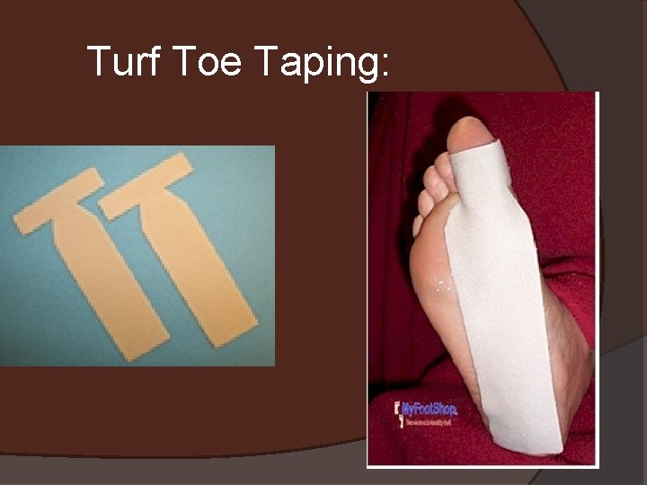 Turf Toe Taping: 