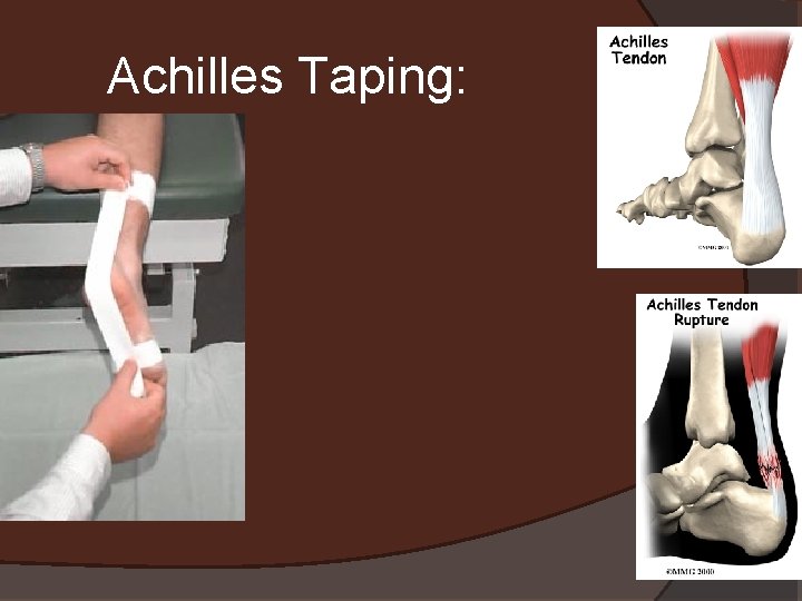 Achilles Taping: 