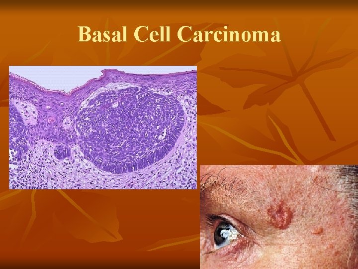 Basal Cell Carcinoma Basal Cell Carcinoma