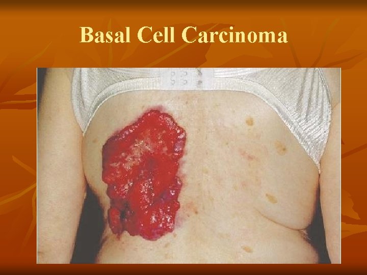 Basal Cell Carcinoma Basal Cell Carcinoma