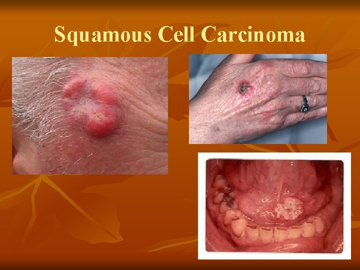 Squamous Cell Carcinoma Squamous Cell Carcinoma