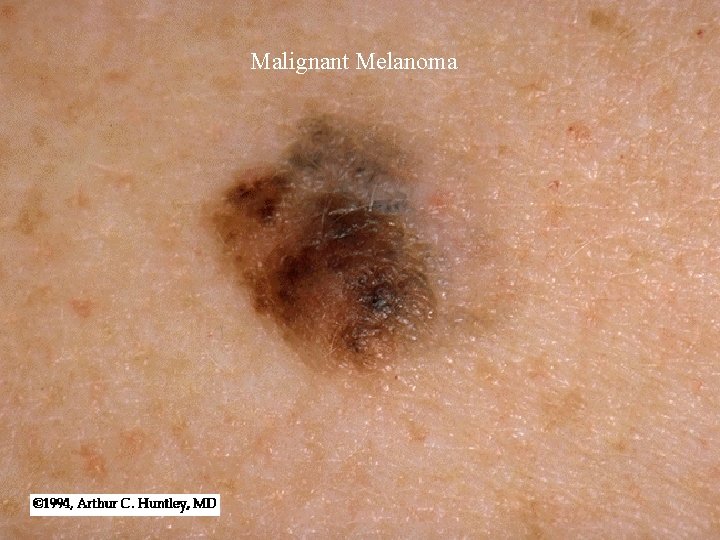 Malignant Melanoma Malignant Melanoma