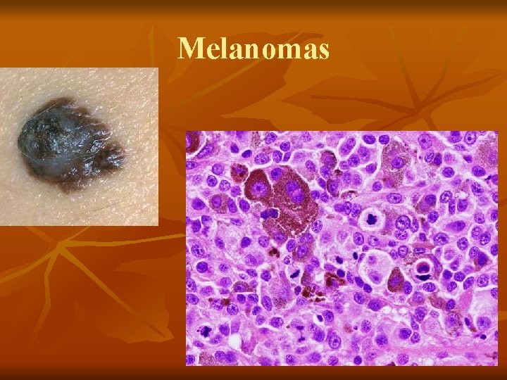 Melanomas Melanomas