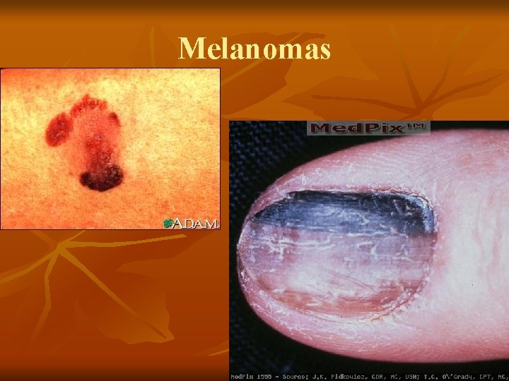 Melanomas Melanomas