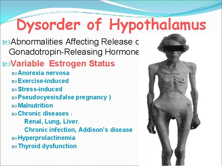 Dysorder of Hypothalamus Abnormalities Affecting Release of Gonadotropin-Releasing Hormone Variable Estrogen Status Anorexia nervosa